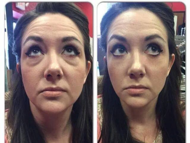 Foto 1 - Botox Instantneo - Instantly ageless